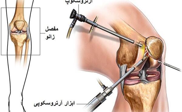 مینیسک عکس ام ار ای پارگی رباط صلیبی زانو
