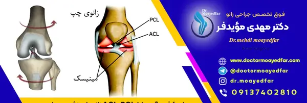 مینیسک عکس ام ار ای پارگی رباط صلیبی زانو