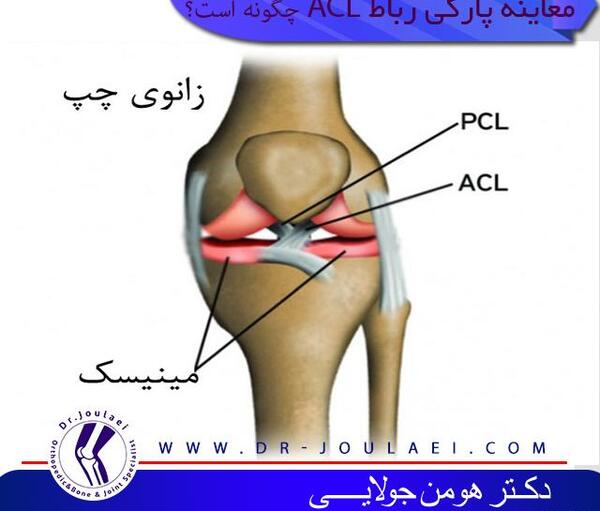 مینیسک عکس ام ار ای پارگی رباط صلیبی زانو