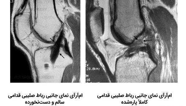مینیسک عکس ام ار ای پارگی رباط صلیبی زانو