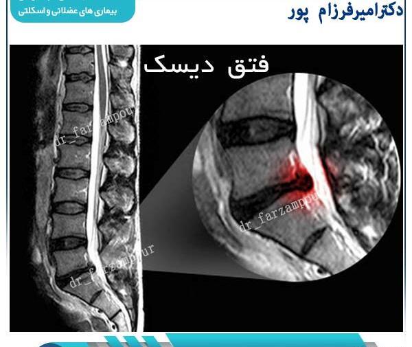 عکس ام ار ای از دیسک کمر