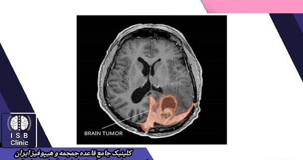 عکس تومور مغزی در ام ار ای