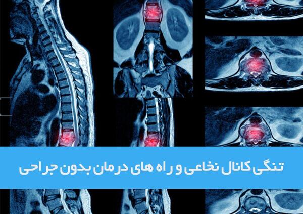 عکس ام ار ای تنگی کانال نخاع گردن