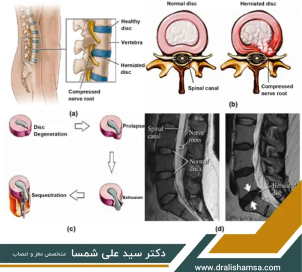 عکس ام ار ای تنگی کانال نخاع گردن