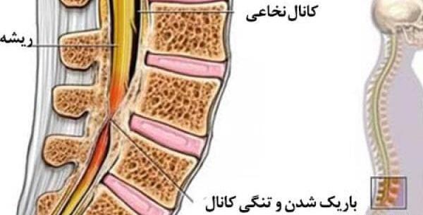 پارگی عکس ام ار ای تنگی کانال نخاع