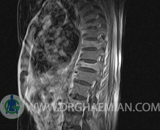 پارگی عکس ام ار ای تنگی کانال نخاع