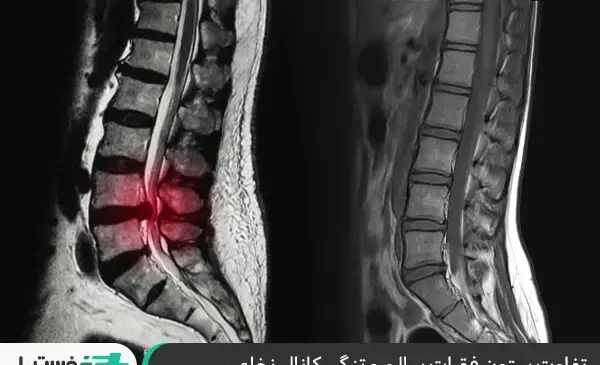 پارگی عکس ام ار ای تنگی کانال نخاع