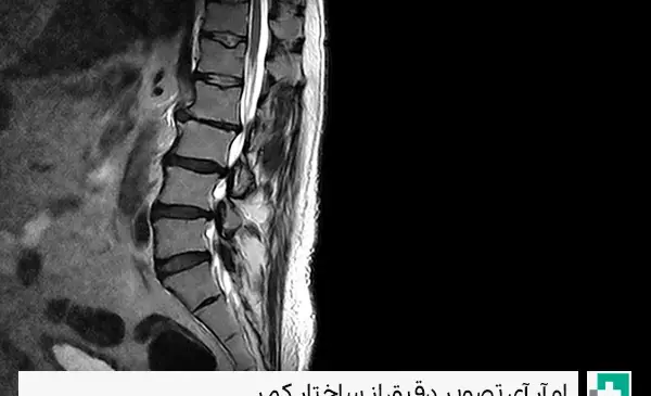 پارگی عکس ام ار ای تنگی کانال نخاع