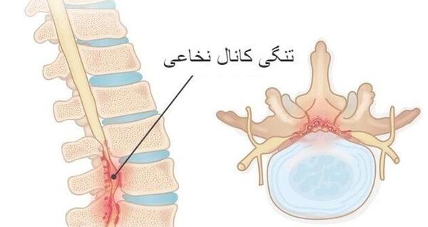 پارگی عکس ام ار ای تنگی کانال نخاع