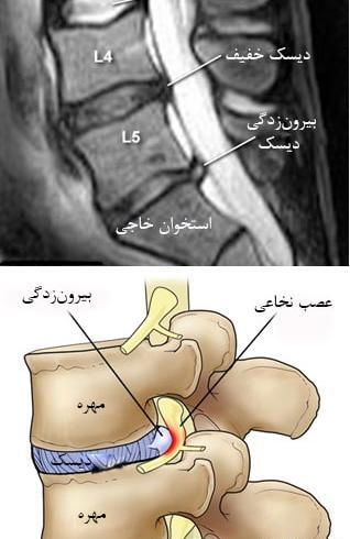 عکس ام ار ای دیسک کمر پاره شده