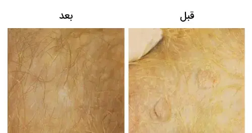 عکس اچ اس وی