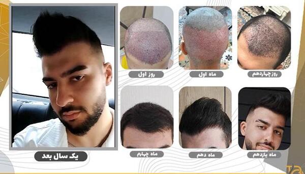 عکس مو کاشته شده