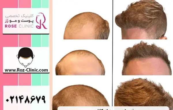 عکس مو کاشته شده