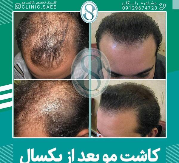 عکس مو کاشته شده