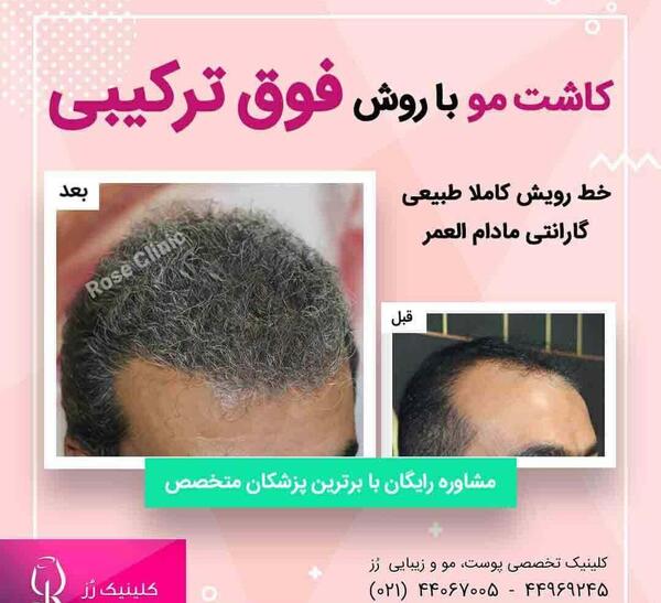 عکس مو کاشته شده