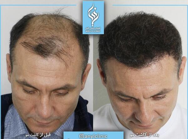 عکس مو کاشته شده