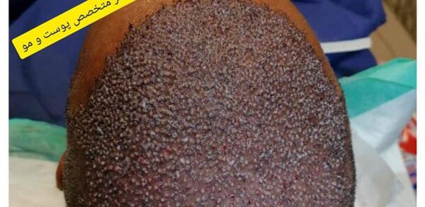 عکس مو کاشته شده