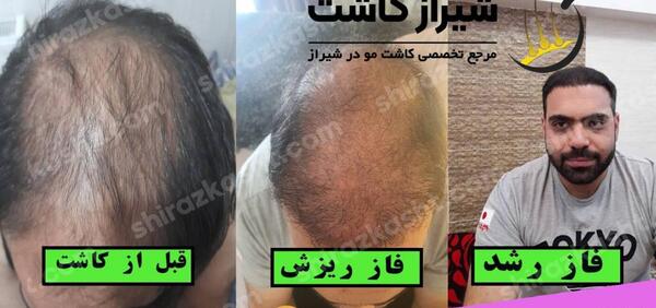 عکس مو کاشته شده