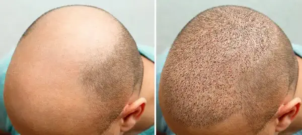 عکس مو کاشته شده