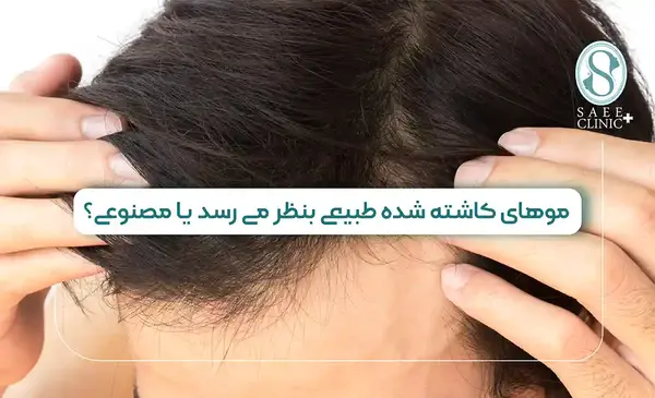 عکس مو کاشته شده