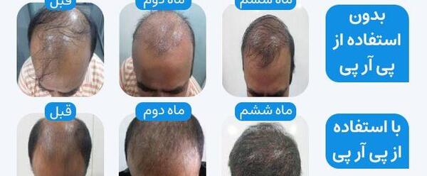 عکس موهای کاشته شده بعد از سه ماه