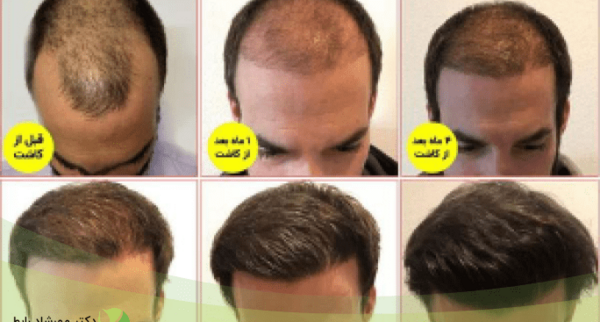 عکس موهای کاشته شده بعد از سه ماه