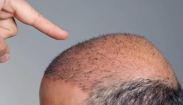 عکس موهای کاشته شده بعد از سه ماه
