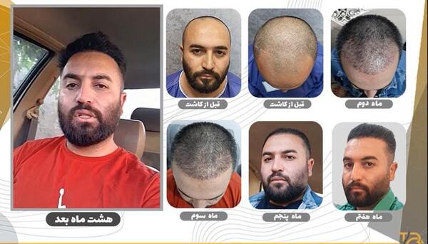 عکس موهای کاشته شده بعد از سه ماه