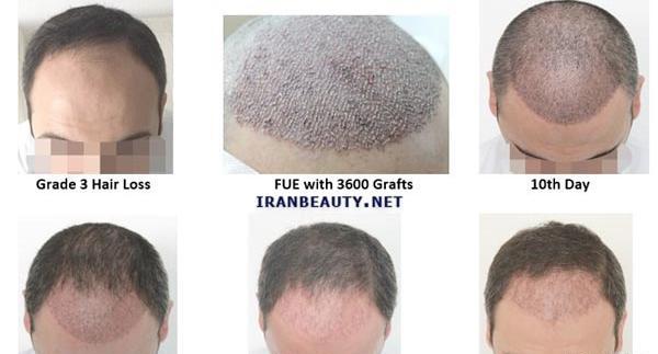 عکس موهای کاشته شده بعد از سه ماه