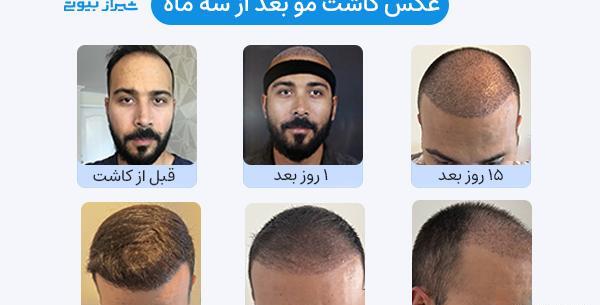 عکس موهای کاشته شده بعد از سه ماه