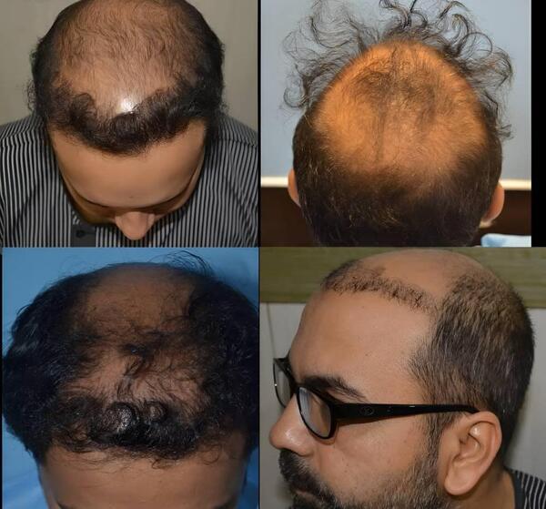 عکس موهای کاشته شده بعد از سه ماه