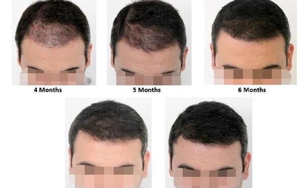 عکس موهای کاشته شده بعد از سه ماه
