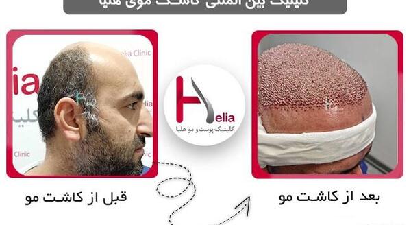عکس موهای کاشته شده بعد از سه ماه
