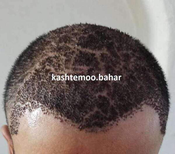 عکس کاشت مو بعد یک هفته