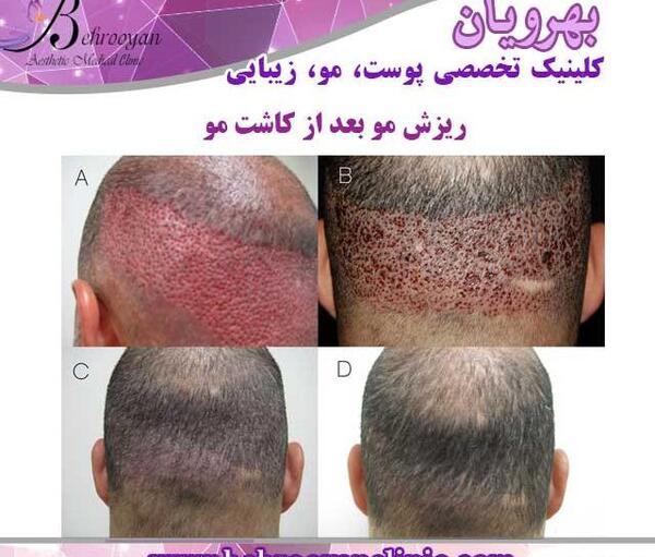 عکس کاشت مو بعد یک هفته