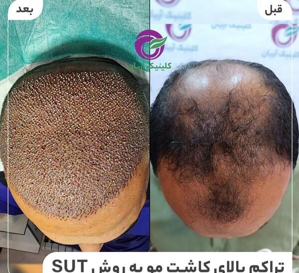 عکس کاشت مو بعد یک هفته
