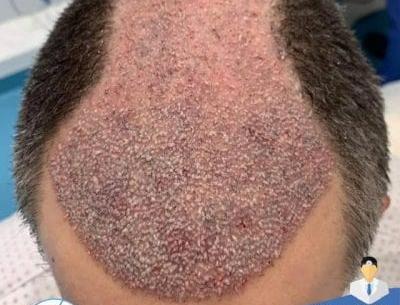 عکس کاشت مو بعد یک هفته
