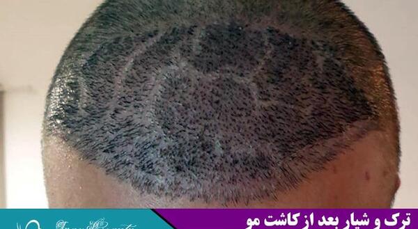عکس کاشت مو بعد یک هفته