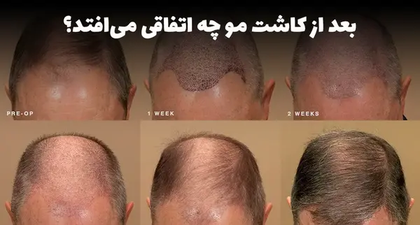 عکس کاشت مو بعد یک هفته