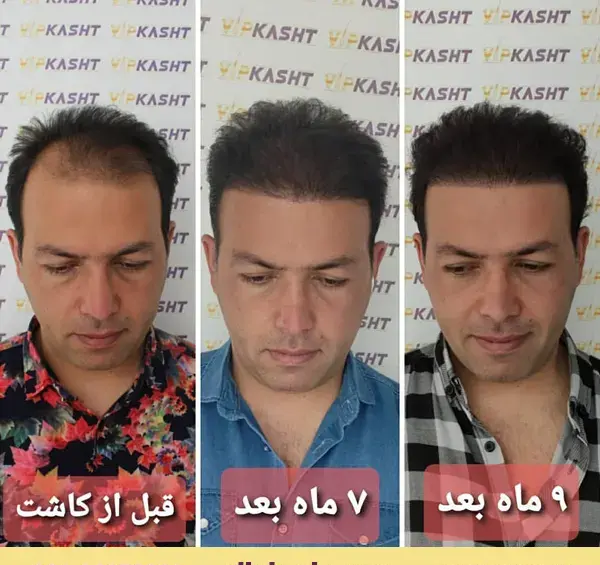 عکس کاشت مو بعد یک هفته