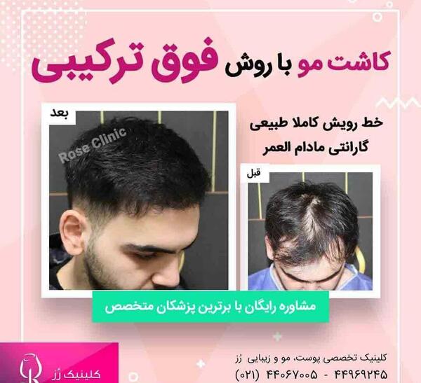 عکس کاشت مو بعد یک هفته