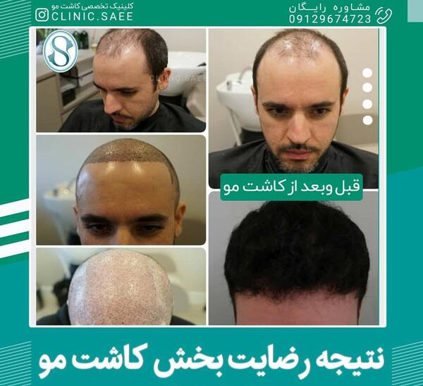 عکس کاشت مو بعد یک هفته