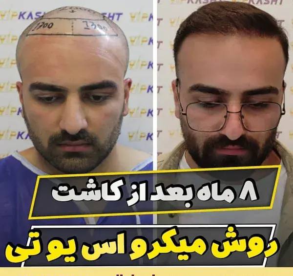عکس کاشت مو بعد از 3 ماه