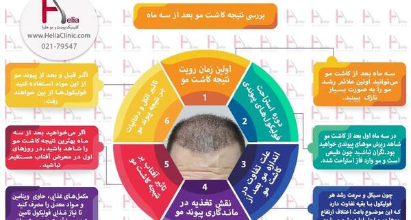 عکس کاشت مو بعد از 3 ماه