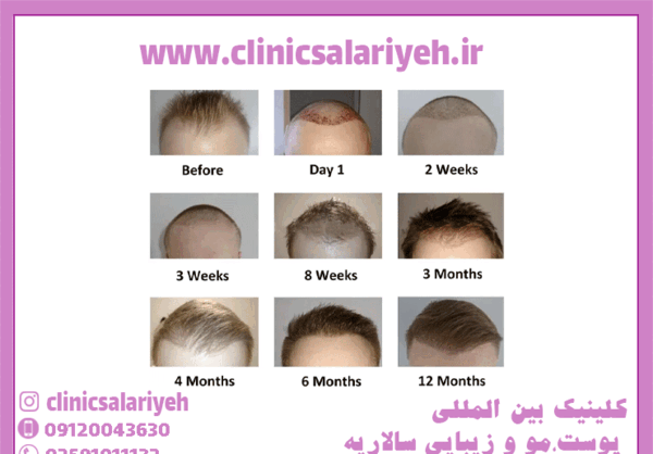 عکس کاشت مو بعد از 3 ماه