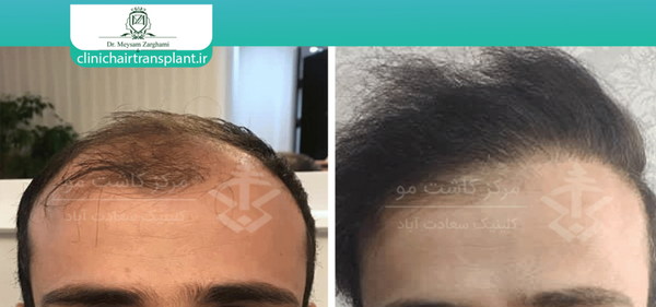 عکس کاشت مو بعد از 3 ماه