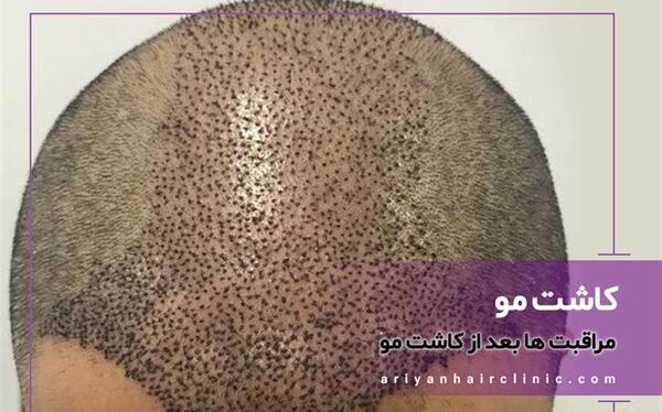 عکس کاشت مو بعد از 3 ماه