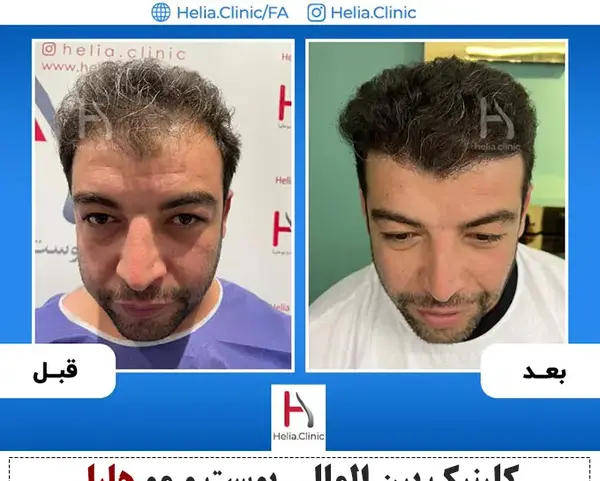 عکس کاشت مو بعد از 3 ماه
