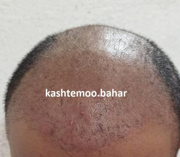 عکس کاشت مو بعد از 3 ماه