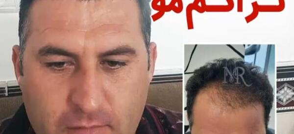 عکس کاشت مو بعد از 3 ماه